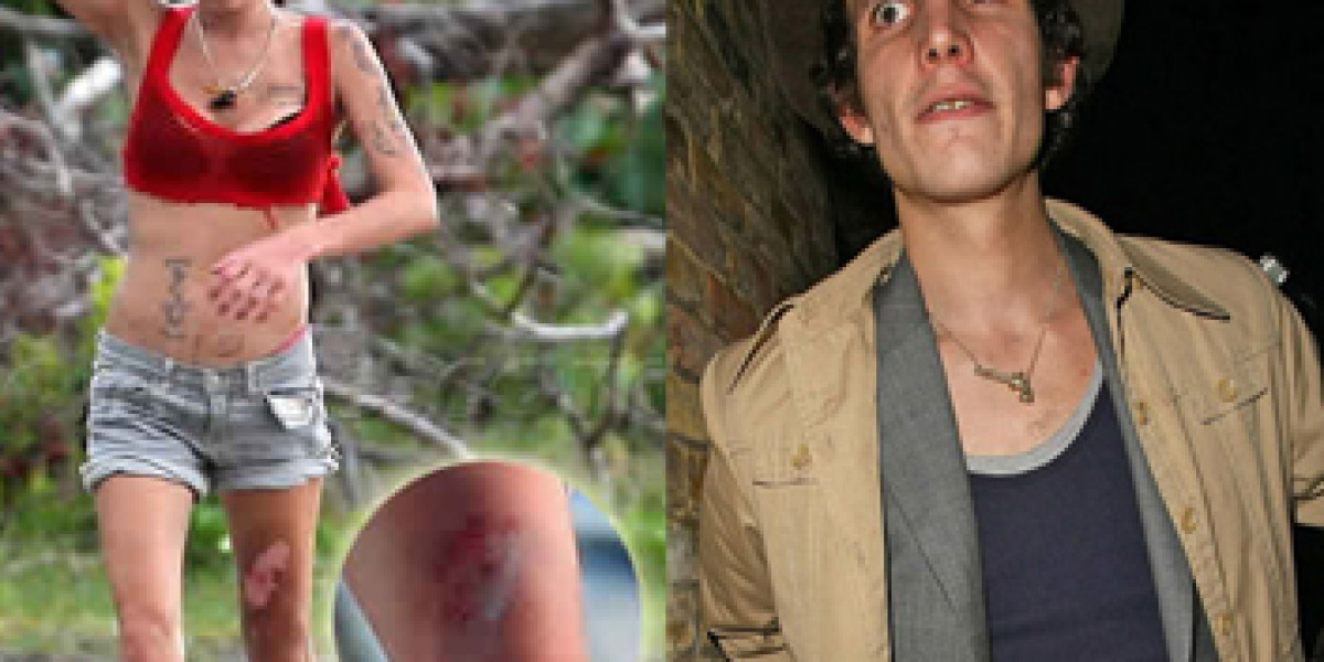 Las quemaduras de Amy y su ex
